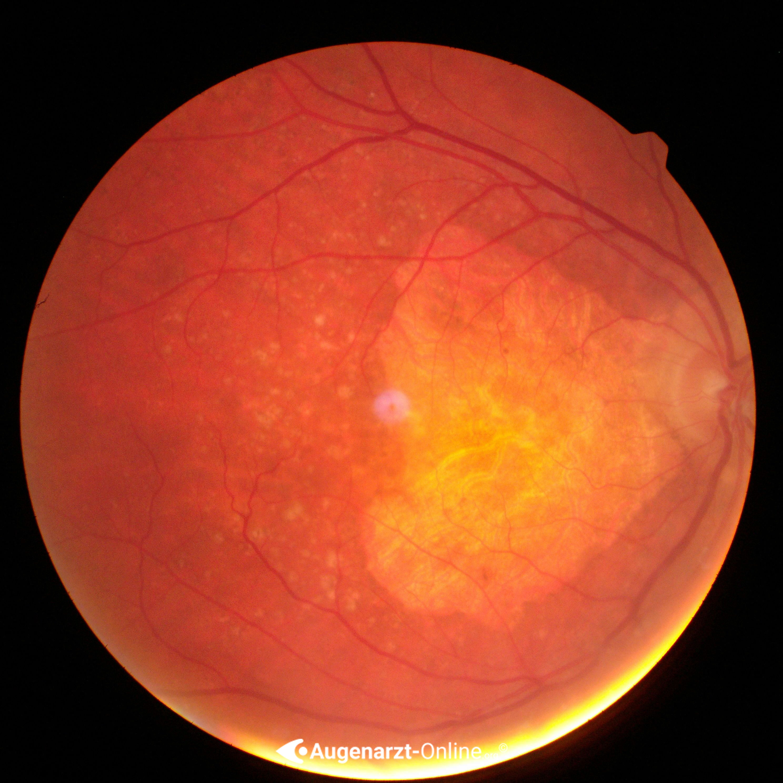 Geographische Atrophie Atlas der Augenheilkunde